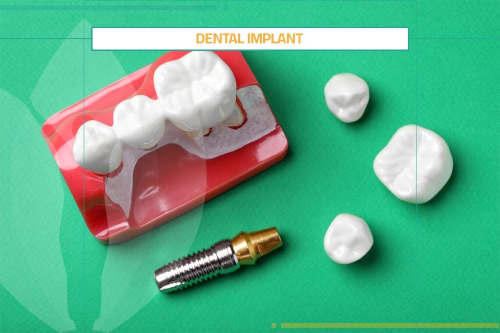 Dental Implant as a Treatment for Missing Teeth