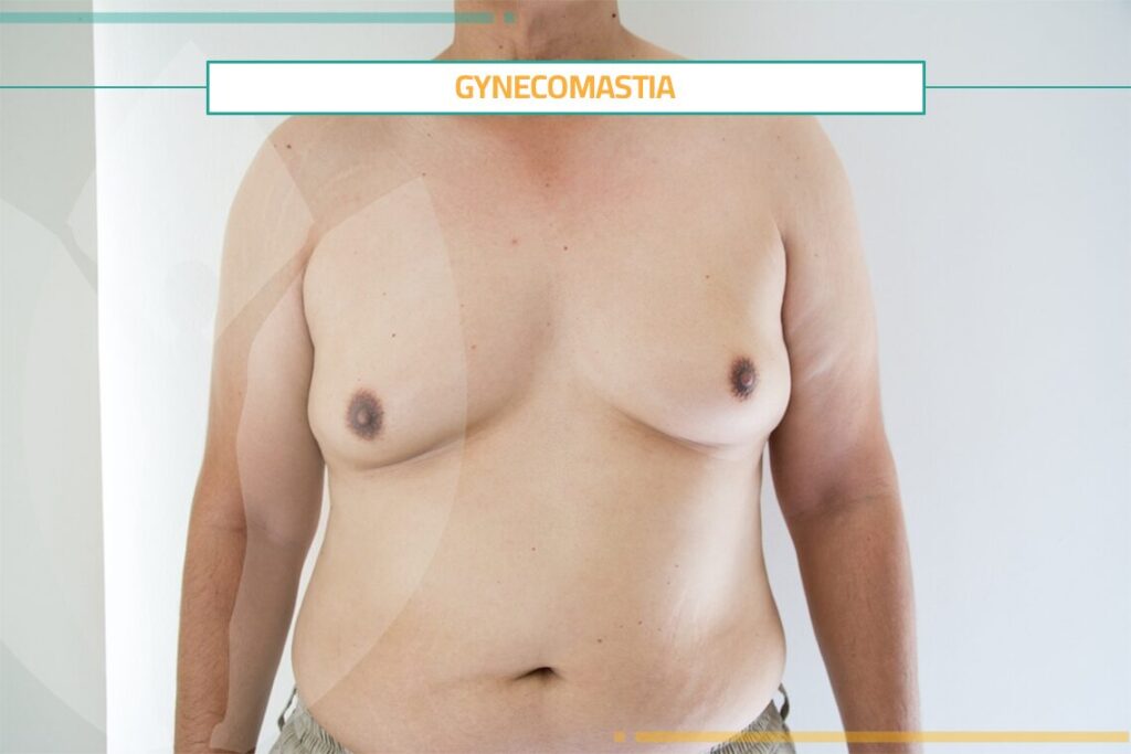 The Ultimate Guide to Gynecomastia: Causes, Symptoms, and Treatments