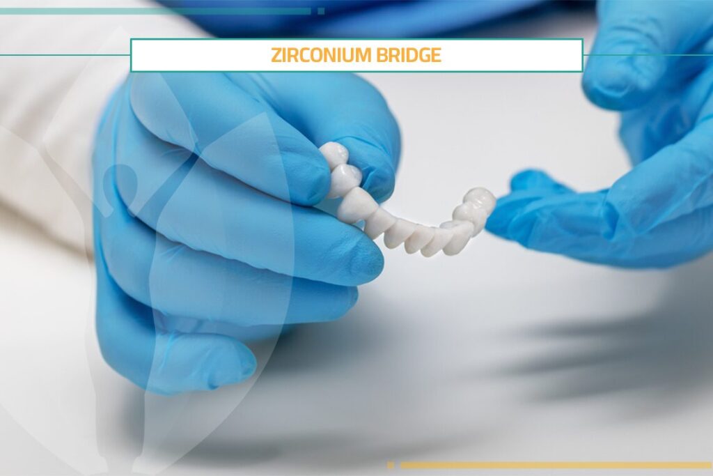 Full Guideline about Zirconium Bridge in Turkey