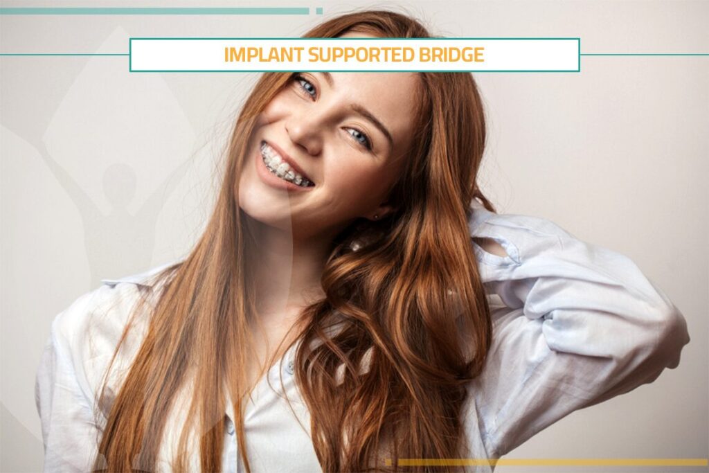 Implant Supported Bridge for Better Oral Health