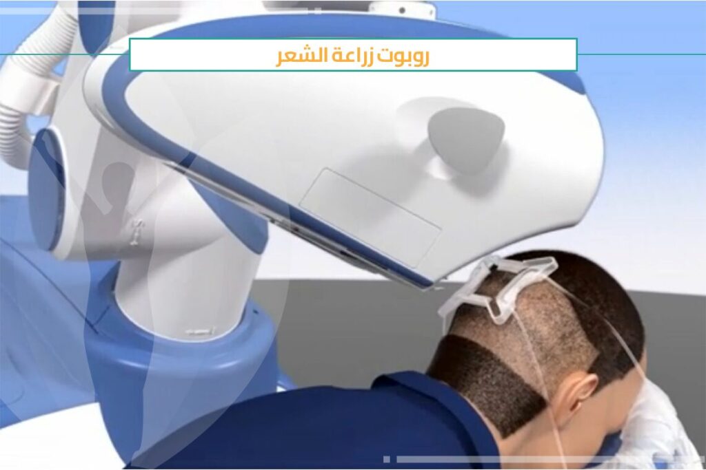 كيف تتم زراعة الشعر بالروبوت ارتاس ARTAS