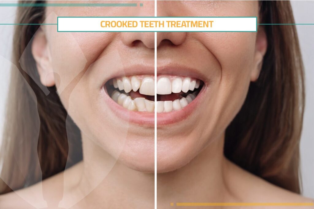 Crooked Teeth Treatment in Turkey