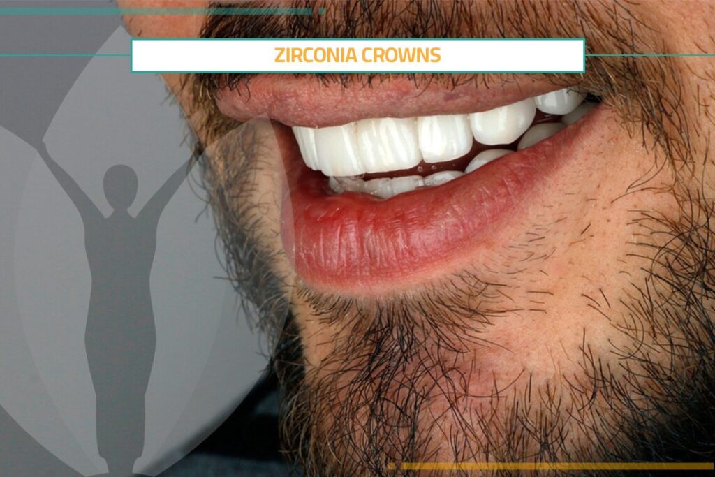 Zirconia Crowns Are the Most Popular Crowns