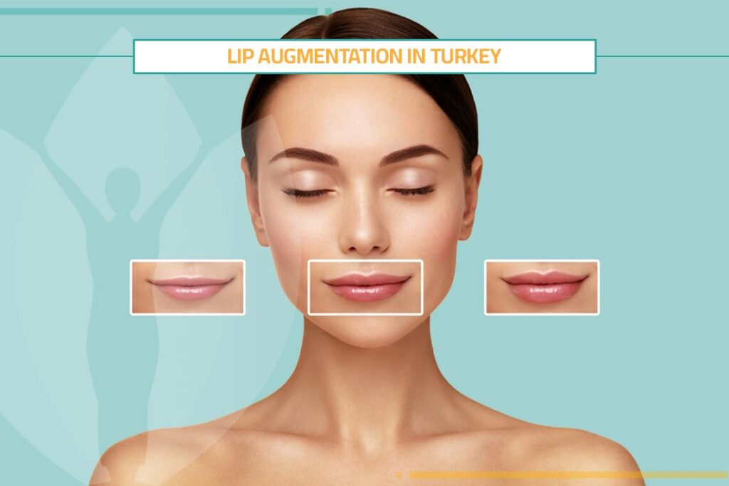 Lip Augmentation in Turkey: Techniques, Prices & Candidates