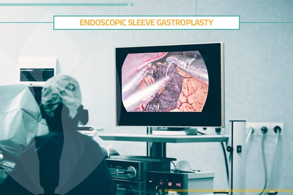 Endoscopic Sleeve Gastroplasty: Procedure & Benefits