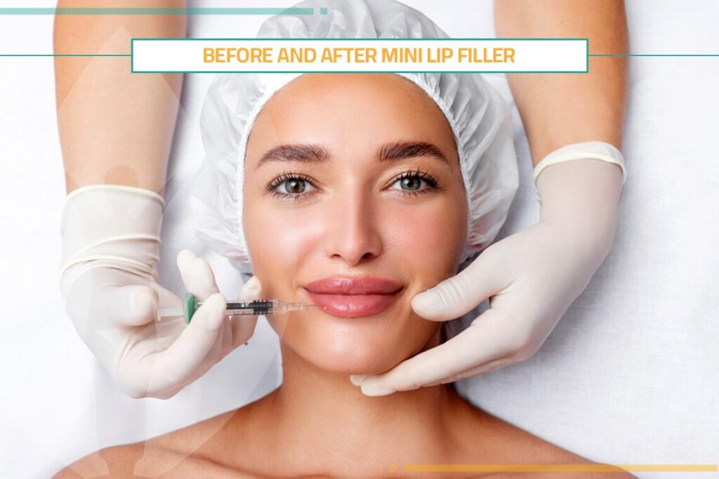 Before and After Mini Lip Filler