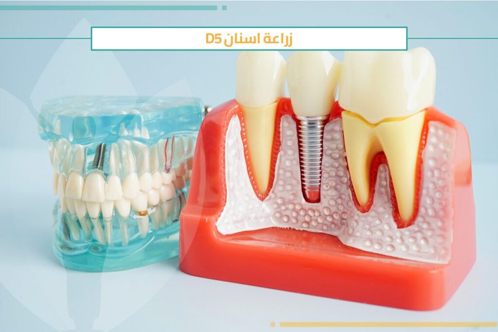 نصائح قبل زراعة الأسنان D5