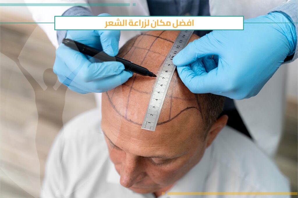 افضل مكان لزراعة الشعر