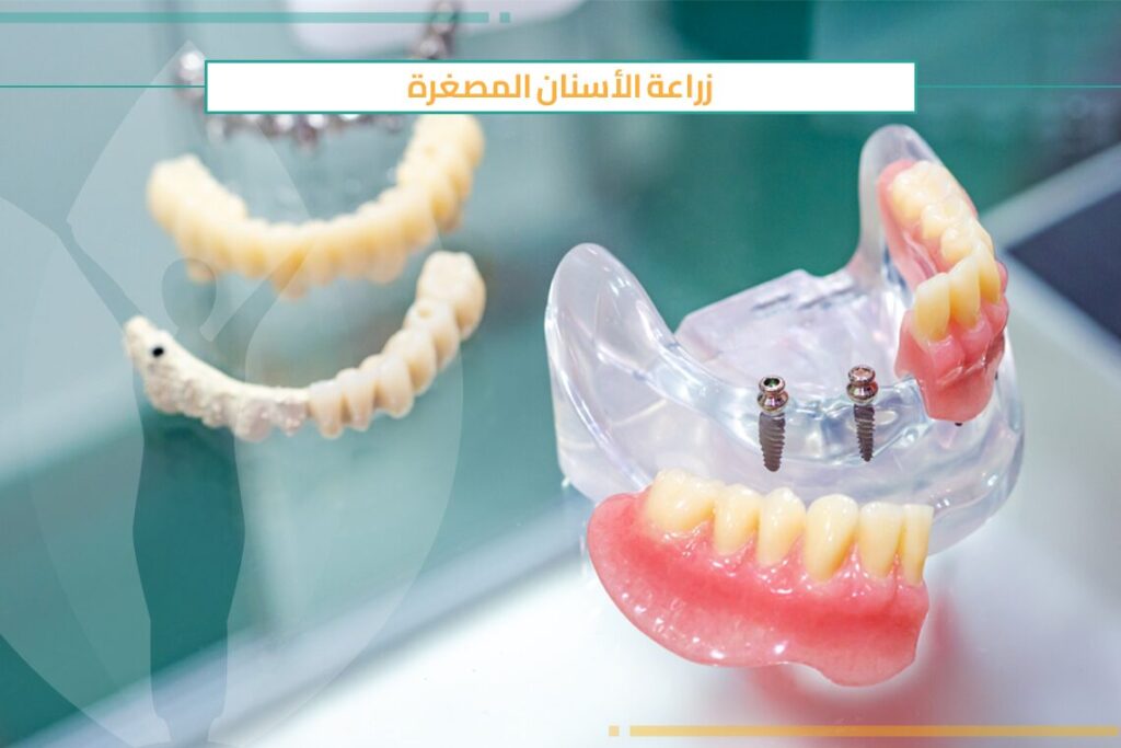 كيف يتم إجراء زراعة الأسنان المصغرة؟