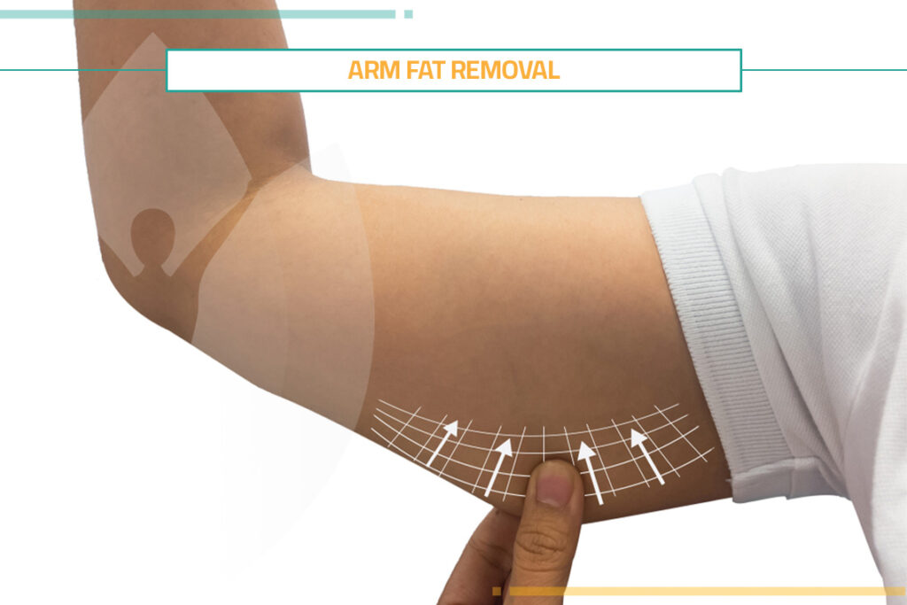 Arm Fat Removal: Comprehensive Guide to Procedures, Costs, & Non-Surgical Solutions