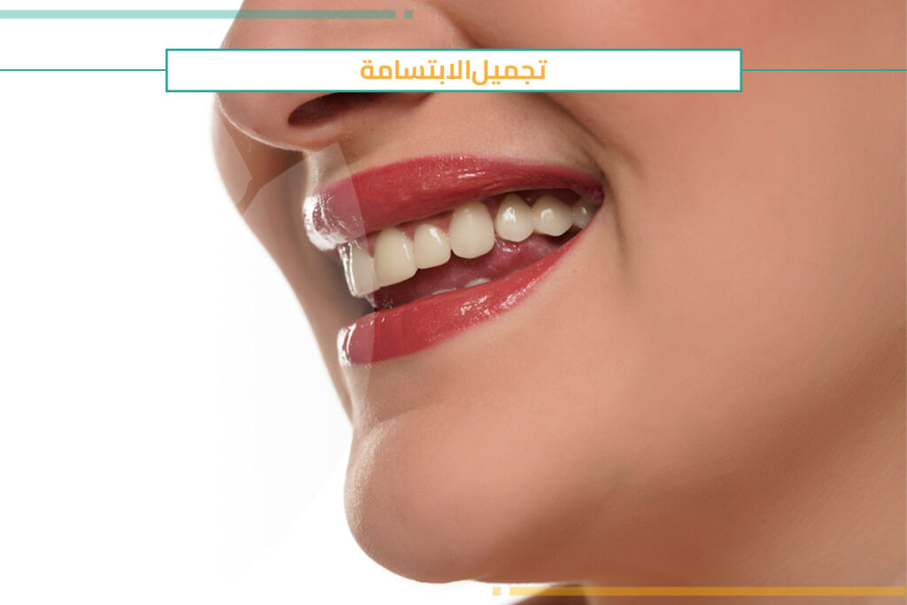 احجز موعد مجاني لإجراء تجميل الابتسامة Mini Smile Makeover