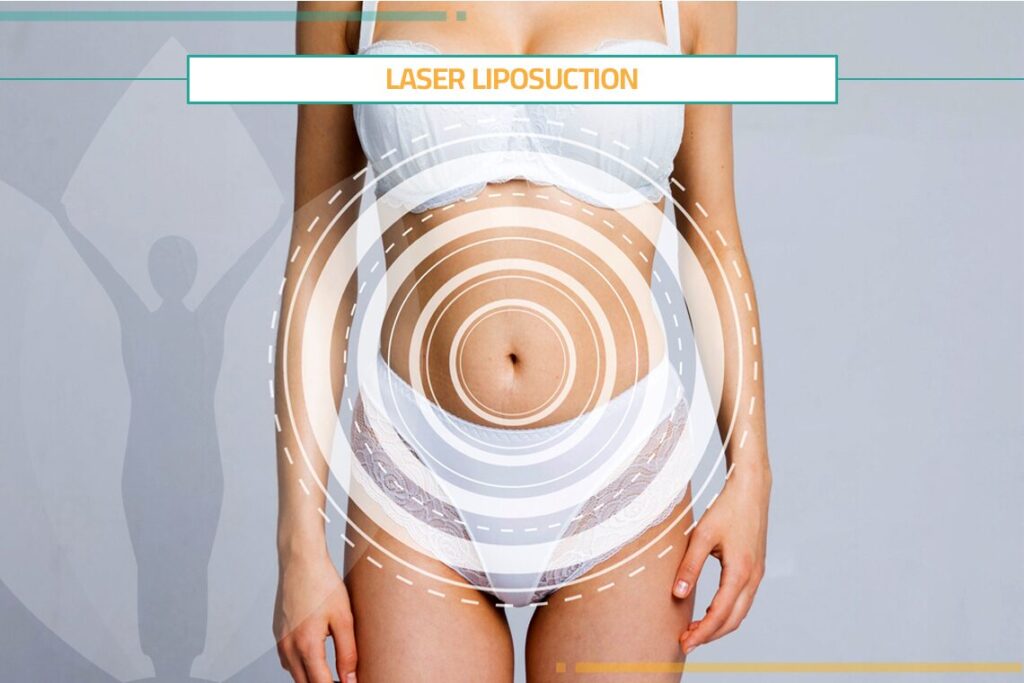 Everything You Need to Know about Laser Liposuction