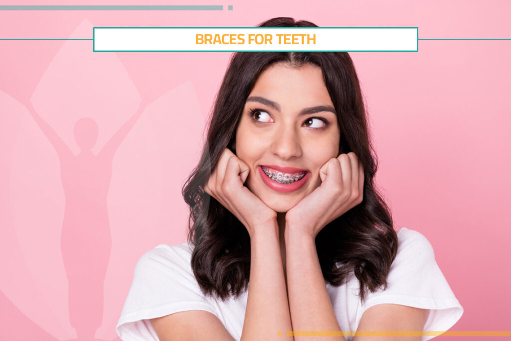 Braces for Teeth: Types of Braces and Cost