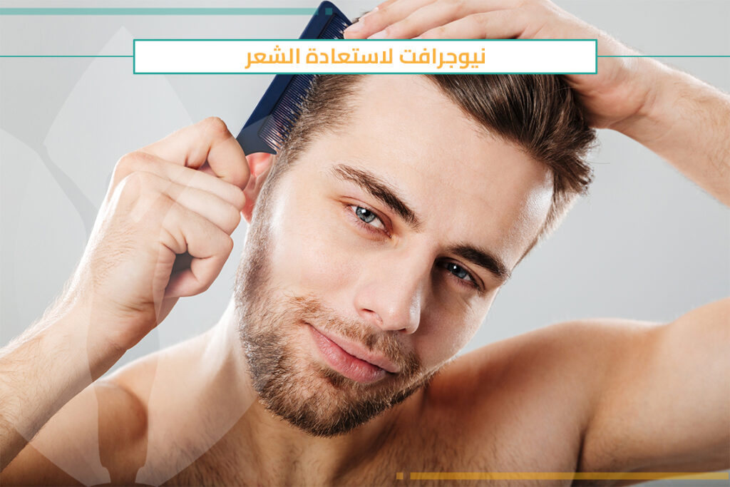 كل ما يجب أن تعرفه عن زراعة الشعر بتقنية النيوجرافت