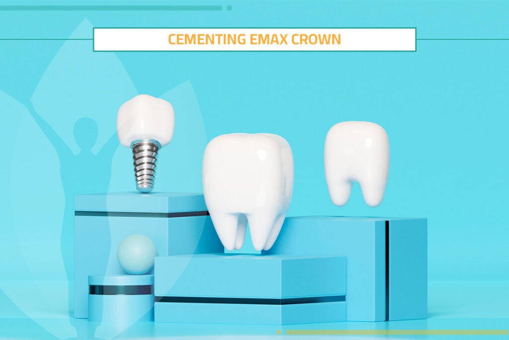 What`s the Best of Cementing Emax Crown?